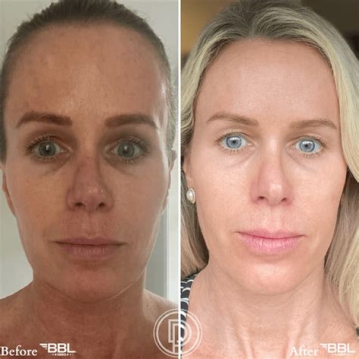 Marlene Oi Mae Grande Before Surgery | Before And After BBL